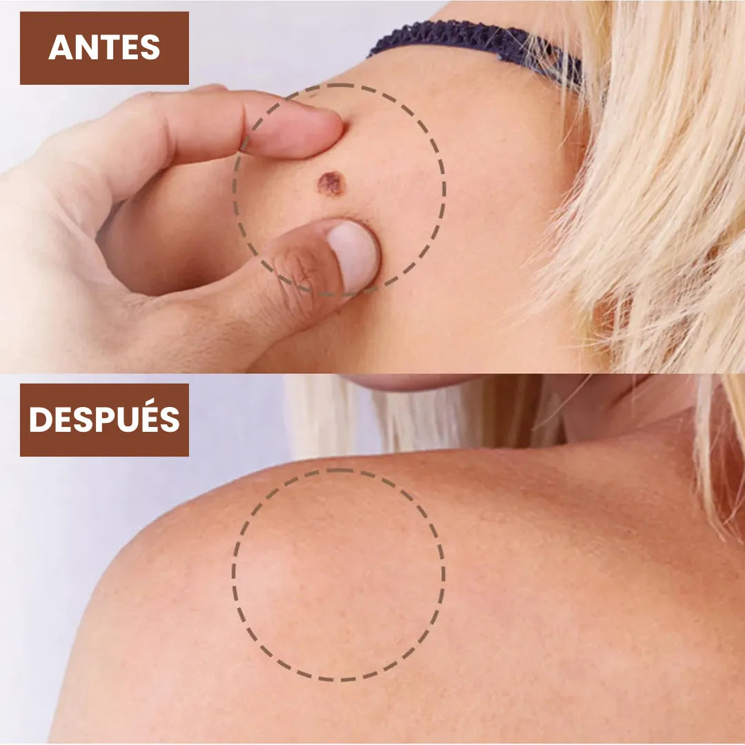 DermaErase™ Crema antiverrugas